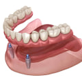 How Implant Overdentures Differ from Traditional Dentures
