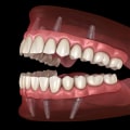 Achieve a Natural-Looking Smile: The Benefits of Implant-Supported Dentures