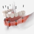 The Importance of Evaluating Oral Health Before Getting Implant Supported Dentures