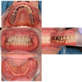 Improving Stability and Fit for Implant Overdentures: A Comprehensive Review