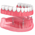 How to Prevent Slipping and Clicking with Implant Supported Dentures