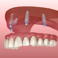 The Healing Period for Implant Supported Dentures