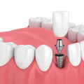 Budgeting for Dental Implants: How to Save Money and Get the Best Results