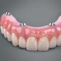 Assessing Bone Density for Implant Supported Dentures