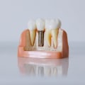 Subperiosteal Implants: A Comprehensive Guide to Understanding This Type of Dental Implant