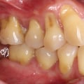 Reducing Risk of Gum Disease: A Comprehensive Guide to Long-Term Oral Health Benefits