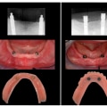 Possible Complications of Implant Supported Dentures