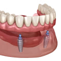Understanding Maintenance Costs for Implant Supported Dentures