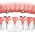 Higher Cost Compared to Traditional Dentures