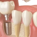 Understanding the Importance of Jawbone Preservation for Dental Implants