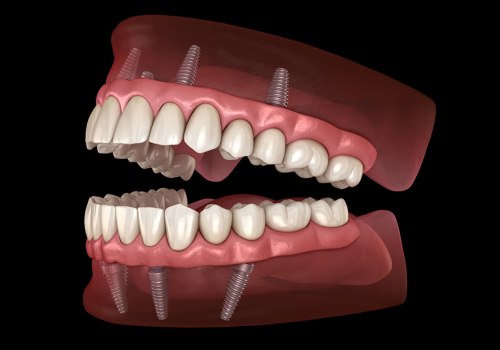 Achieve a Natural-Looking Smile: The Benefits of Implant-Supported Dentures