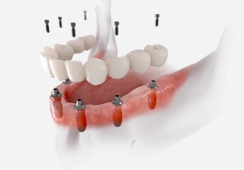 The Importance of Evaluating Oral Health Before Getting Implant Supported Dentures