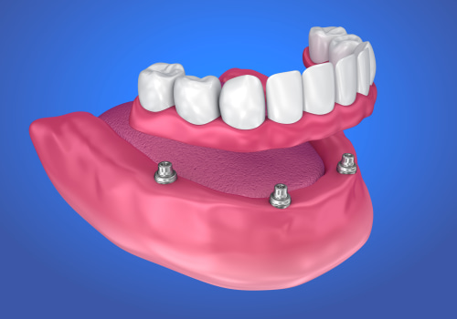 How to Choose the Right Material for Your Implant-Supported Dentures