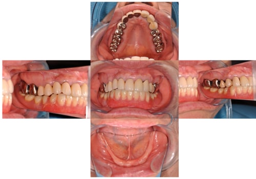 Improving Stability and Fit for Implant Overdentures: A Comprehensive Review