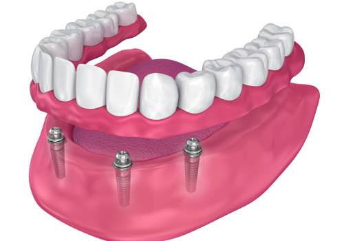 How Many Implants Do You Really Need for Implant Supported Dentures?