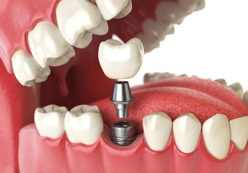 The True Cost of Implants: What You Need to Know