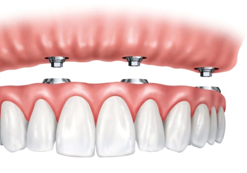 Understanding the Differences between Implant Supported Dentures and Traditional Dentures