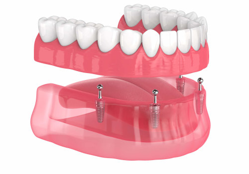 How to Prevent Slipping and Clicking with Implant Supported Dentures