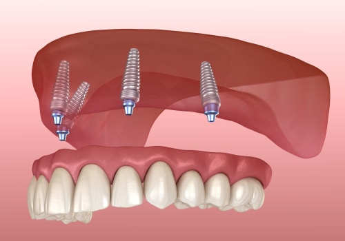The Healing Period for Implant Supported Dentures