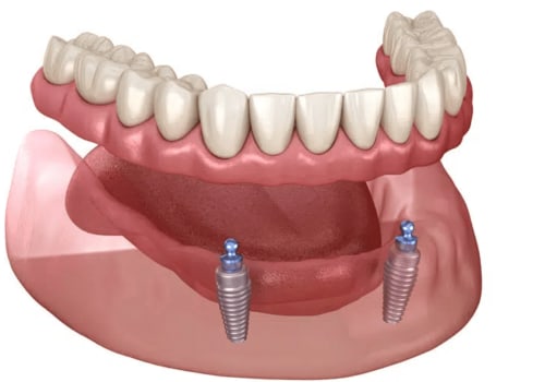 The Convenience and Comfort of Adhesive-Free Implant Supported Dentures