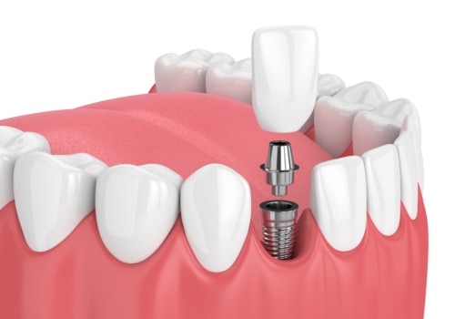 Budgeting for Dental Implants: How to Save Money and Get the Best Results