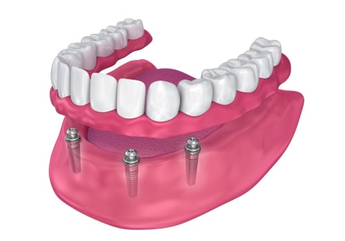 Creating Dentures: A Comprehensive Guide to the Process of Getting Implant Supported Dentures