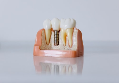 Subperiosteal Implants: A Comprehensive Guide to Understanding This Type of Dental Implant