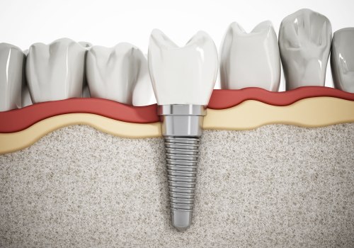 All You Need to Know About Stability and Support for Dental Implants