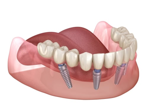 The Benefits of Implant Supported Dentures