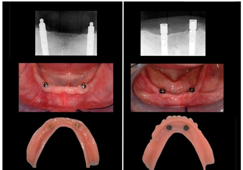 Possible Complications of Implant Supported Dentures