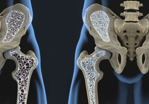 Understanding Bone Density: What You Need to Know